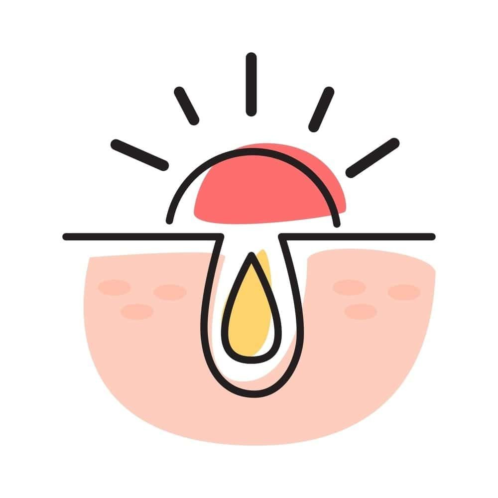 မိန်းမကိုယ်မှာပေါက်တဲ့ ဝက်ခြံအတွက် ဖြေရှင်းနည်း