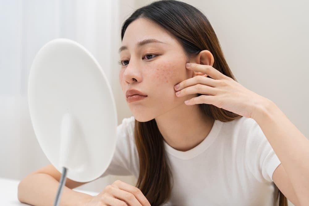 မျက်နှာမှာ ဝက်ခြံတွေ ဘာကြောင့်ဖြစ်ရတာလဲ!