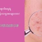 ဝက်ခြံက ပြင်းထန်တဲ့ ကျန်းမာရေးပြဿနာတစ်ရပ်ရပ်ရဲ့ ရှေ့ပြေးဖြစ်နိုင်လား!