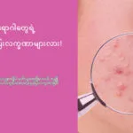 ဝက်ခြံက ပြင်းထန်တဲ့ ကျန်းမာရေးပြဿနာတစ်ရပ်ရပ်ရဲ့ ရှေ့ပြေးဖြစ်နိုင်လား!