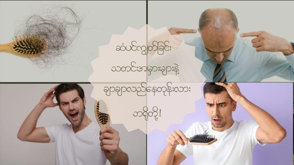 ဆံပင်ကျွတ်ရခြင်း သတင်းအမှားများနဲ့ ချာလည်လည်နေတုန်းလား ဘရို!