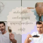 ဆံပင်ကျွတ်ရခြင်း သတင်းအမှားများနဲ့ ချာလည်လည်နေတုန်းလား ဘရို!