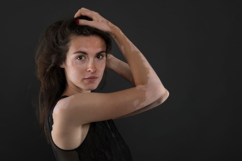 ခရုသင်း ကူးစက်တတ်သလား!